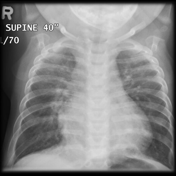 File:Atrioventricular septal defect (Radiopaedia 7454).jpg
