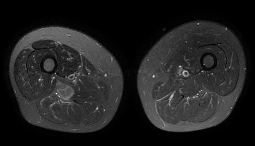 Atypical lipomatous tumor - thigh (Radiopaedia 68975-78734 Axial T2 fat sat 47).jpg