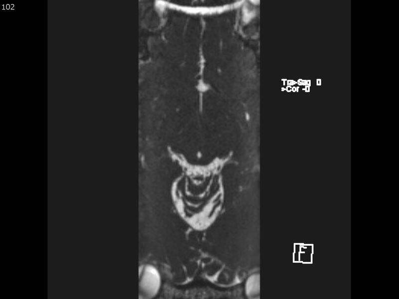 File:Atypical meningioma - intraosseous (Radiopaedia 64915-74572 Axial CISS 102).jpg