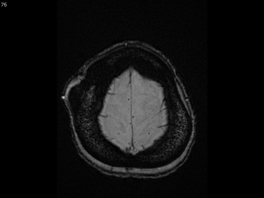Atypical meningioma - intraosseous (Radiopaedia 64915-74572 Axial SWI 76).jpg