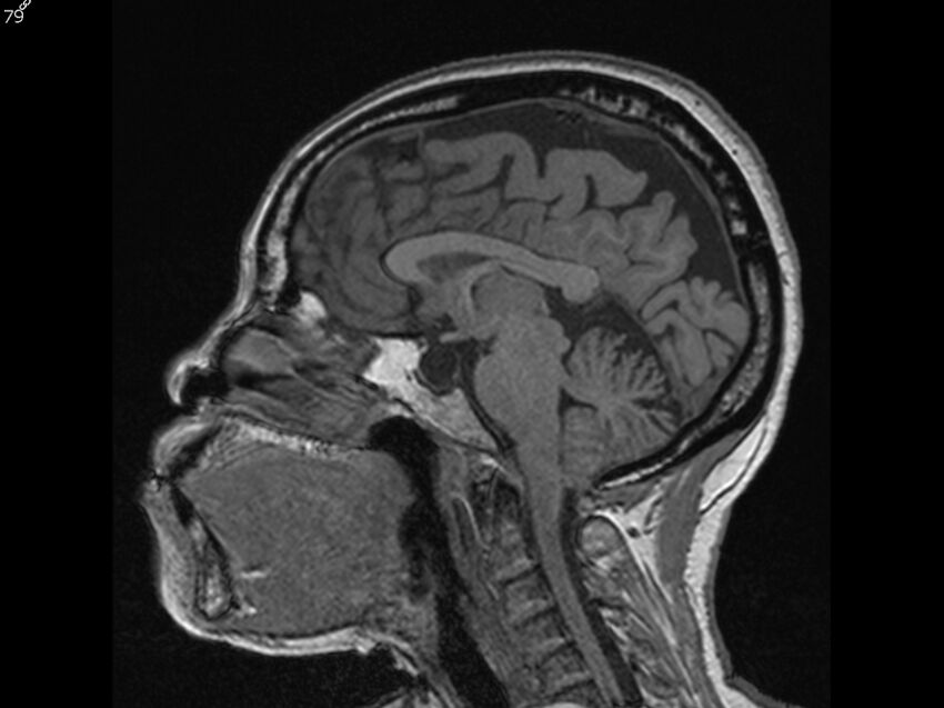 Atypical meningioma - intraosseous (Radiopaedia 64915-74572 Sagittal T1 79).jpg