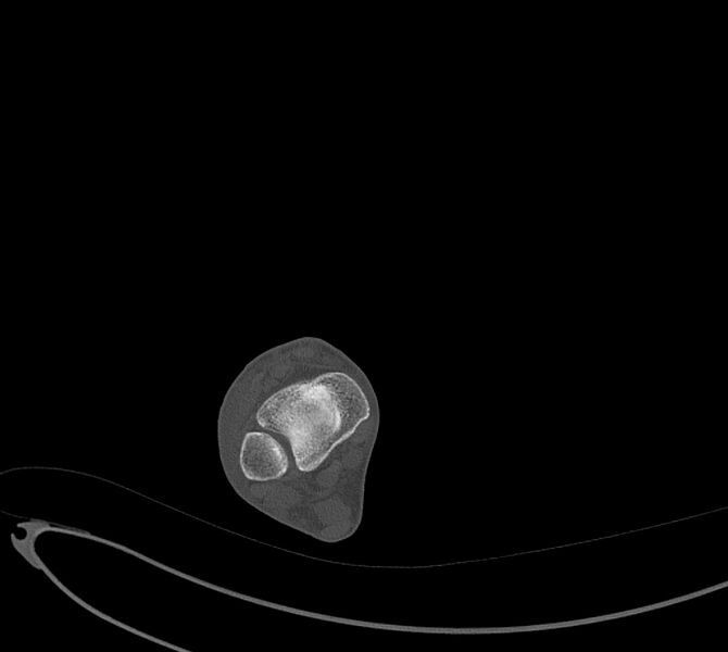 File:Avulsion fractures of talus and calcaneus (Radiopaedia 48277-53155 Axial bone window 1).jpg