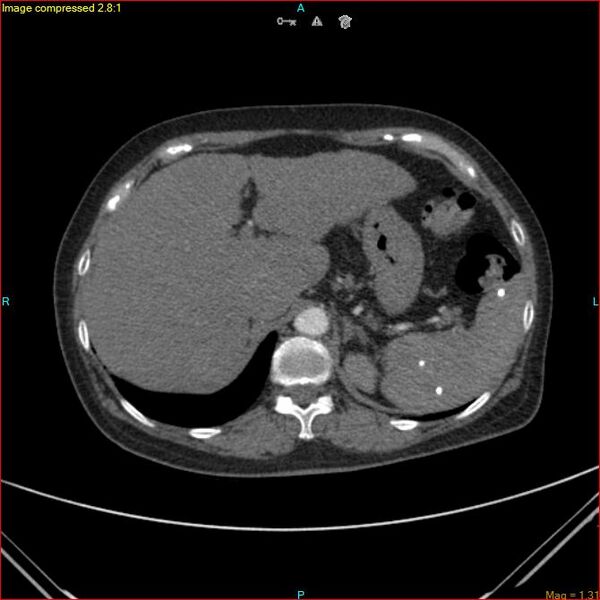 File:Azygos vein aneurysm (Radiopaedia 77824-90130 B 50).jpg