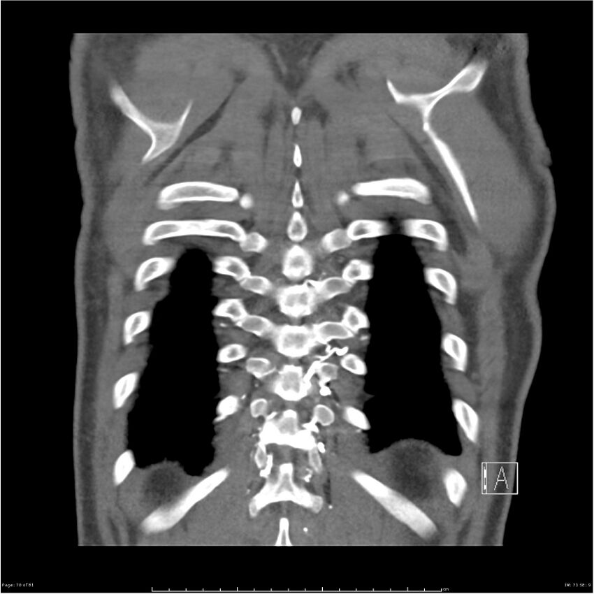 Azygos venous system anatomy (CT pulmonary angiography) (Radiopaedia 25928-26077 Coronal C+ CTPA 70).jpg