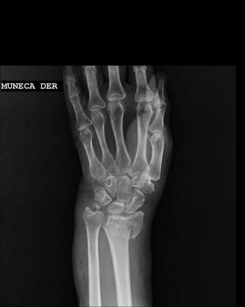 File:Barton fracture - dorsal type (Radiopaedia 79209-92210 Frontal 1).jpg
