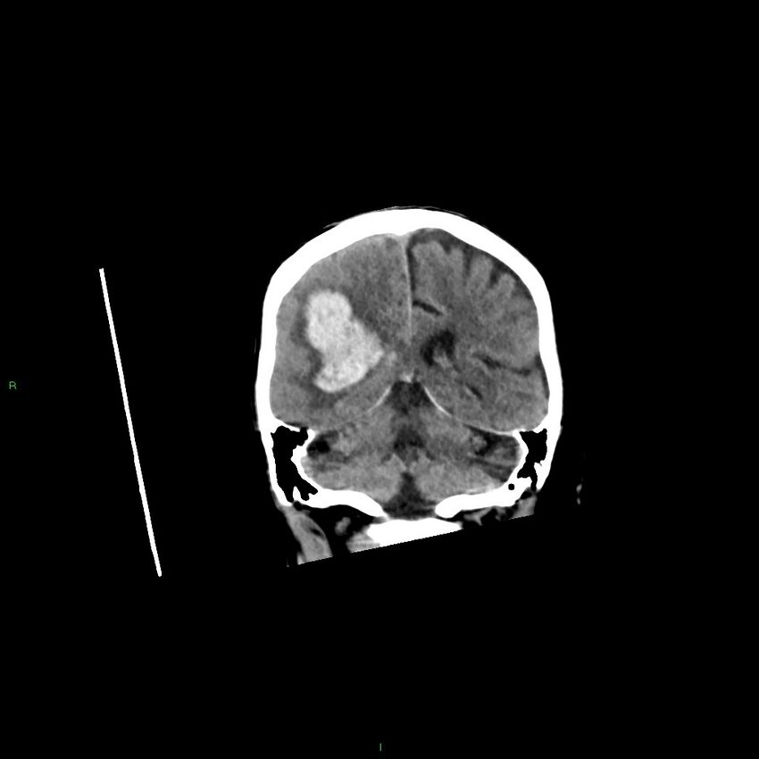 Basal ganglia hemorrhage (Radiopaedia 58350-65473 Coronal non-contrast 23).jpg