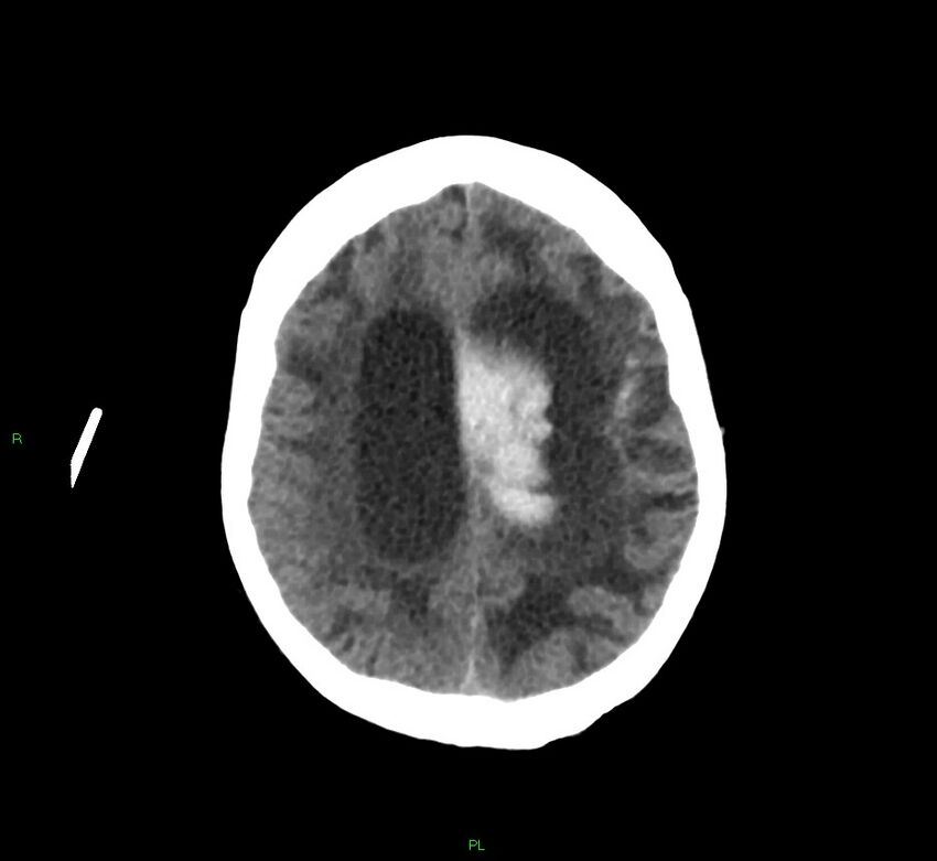 Basal ganglia hemorrhage (Radiopaedia 58766-65988 Axial non-contrast 21).jpg
