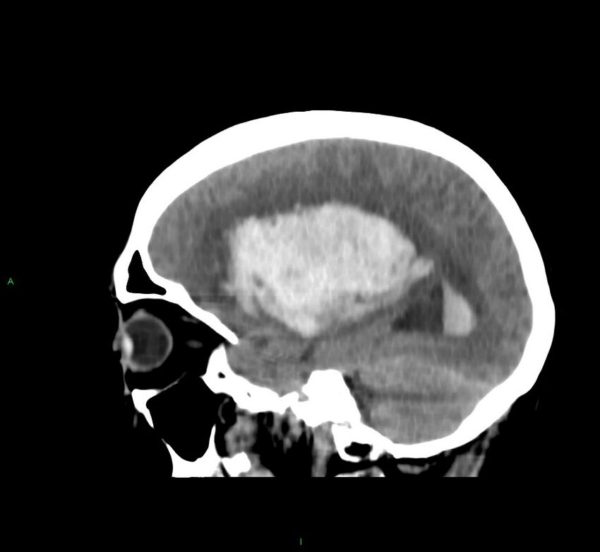 Basal ganglia hemorrhage (Radiopaedia 58767-65989 C 35).jpg