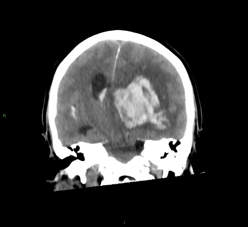 Basal ganglia hemorrhage (Radiopaedia 58775-66008 Coronal non-contrast 33).jpg