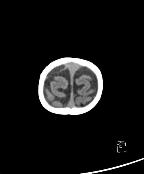 File:Benign enlargement of subarachnoid spaces in infancy (BESS) (Radiopaedia 87459-103795 Axial non-contrast 5).jpg