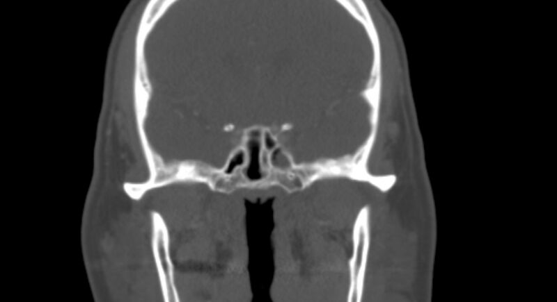 File:Benign mixed salivary tumor of the parotid gland (Radiopaedia 35261-36792 Coronal bone window 14).jpg