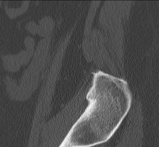 File:Bertolotti syndrome (Radiopaedia 24864-25128 Sagittal bone window 3).jpg