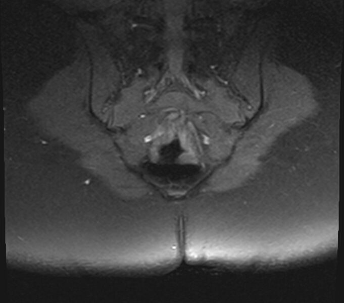 File:Bicornuate uterus (Radiopaedia 71214-81511 Coronal T1 fat sat 1).jpg