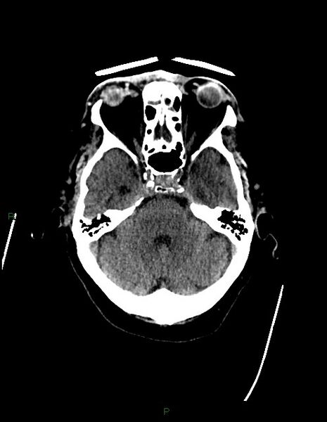 File:Bilateral acute middle cerebral artery territory infarcts (Radiopaedia 77319-89401 Axial non-contrast 24).jpg
