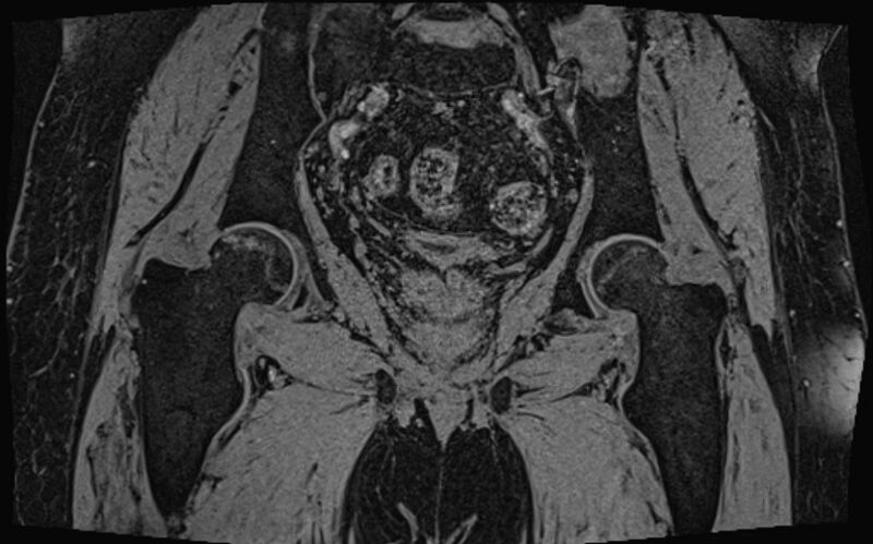 File:Bilateral avascular necrosis of femoral head (Radiopaedia 77116-89078 Coronal T2 we 25).jpg