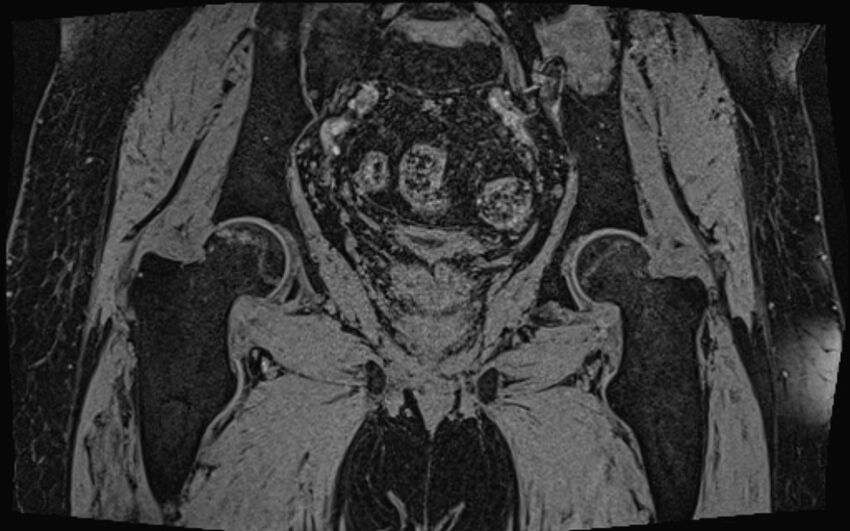 Bilateral avascular necrosis of femoral head (Radiopaedia 77116-89078 Coronal T2 we 25).jpg