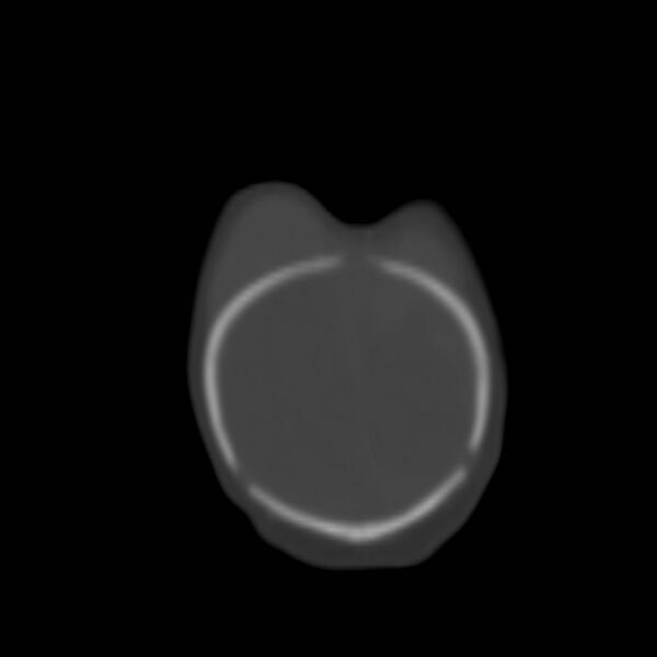 File:Bilateral cephalohematomas and subdural hematomas (Radiopaedia 26778-26929 Coronal bone window 34).jpg