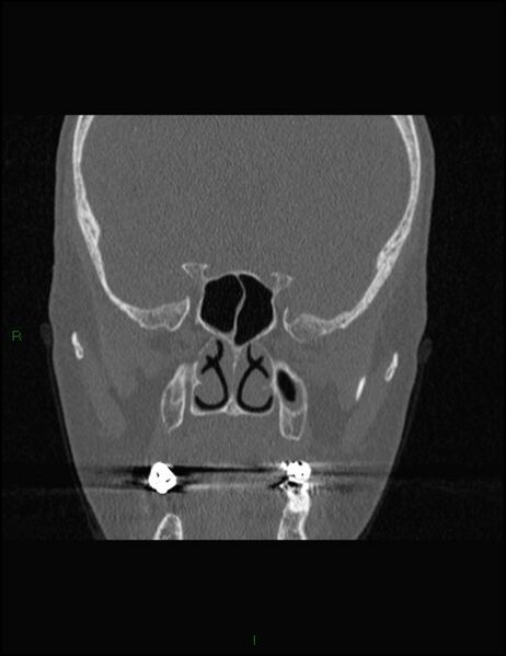 File:Bilateral frontal mucoceles (Radiopaedia 82352-96454 Coronal 195).jpg