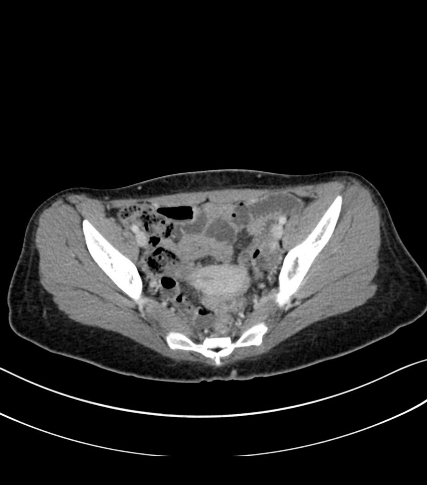 Bilateral kidney malrotation (Radiopaedia 72227-82749 A 58).jpg