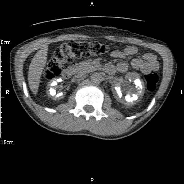File:Bilateral medullary nephrocalcinosis with ureteric calculi (Radiopaedia 71269-81569 Axial non-contrast 42).jpg