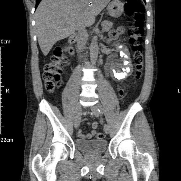 File:Bilateral medullary nephrocalcinosis with ureteric calculi (Radiopaedia 71269-81569 Coronal non-contrast 36).jpg