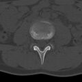 Bilateral pars defect (Radiopaedia 26691-26846 Axial bone window 11).jpg