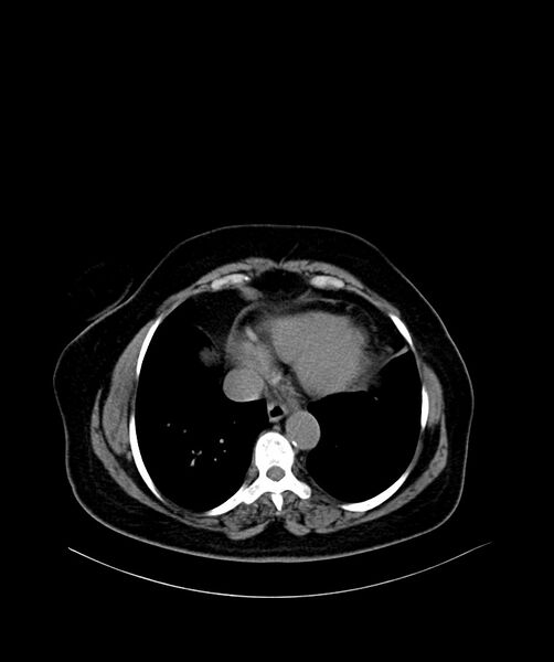 File:Bilateral sporadic synchronous clear cell renal cell carcinoma (Radiopaedia 85035-100572 Axial non-contrast 2).jpg