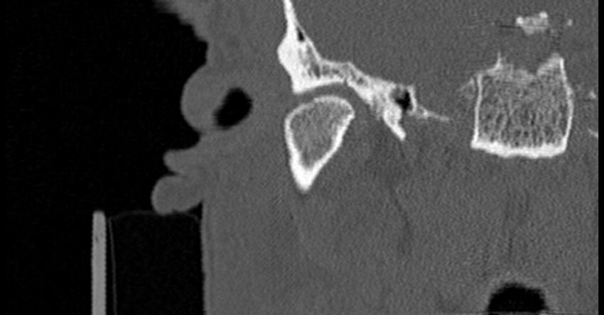Bilateral temporal bone fractures (Radiopaedia 29482-29970 Coronal non-contrast 59).jpg