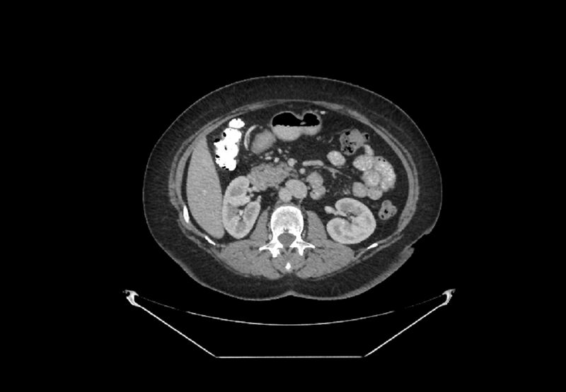 File:Bilateral urolithiasis with incidentally detected splenic artery aneurysm and left inferior vena cava (Radiopaedia 44467-48127 B 42).jpg
