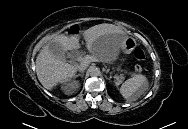 File:Biliary pancreatitis (Radiopaedia 72289-82823 Axial non-contrast 86).jpg