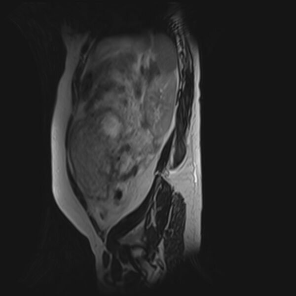 File:Bilobed placenta accreta (Radiopaedia 69648-79591 G 11).jpg