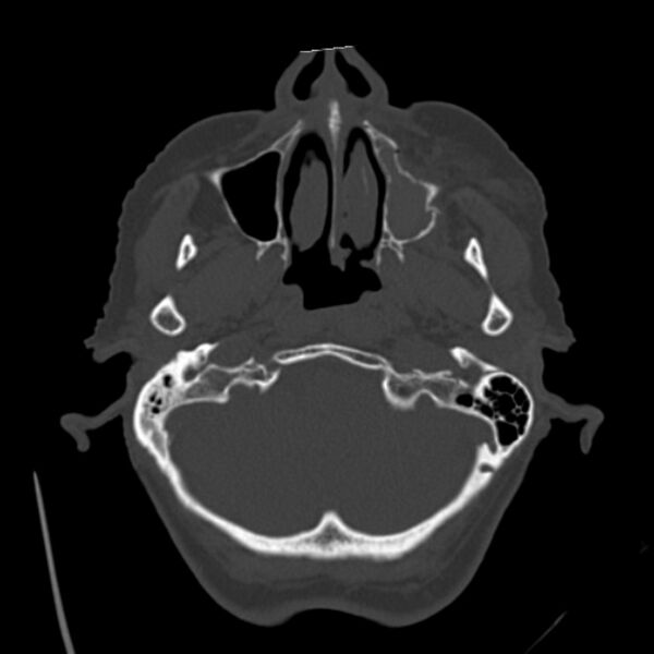 File:Biparietal osteodystrophy (Radiopaedia 46109-50463 bone window 12).jpg