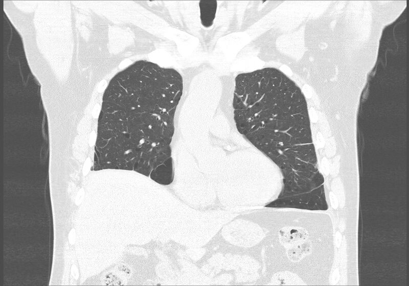 File:Birt-Hogg-Dubé syndrome (Radiopaedia 52578-58491 Coronal lung window 17).jpg