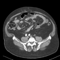 Bladder papillary urothelial carcinoma (Radiopaedia 48119-52951 A 36).png