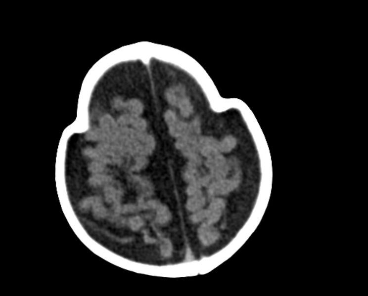 File:Brachycephaly (bi-coronal and bi-lambdoid synostosis) (Radiopaedia 55048-61413 Axial non-contrast 44).jpg