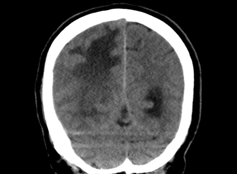 File:Brain abscess complicated by intraventricular rupture and ventriculitis (Radiopaedia 82434-96575 Coronal non-contrast 23).jpg