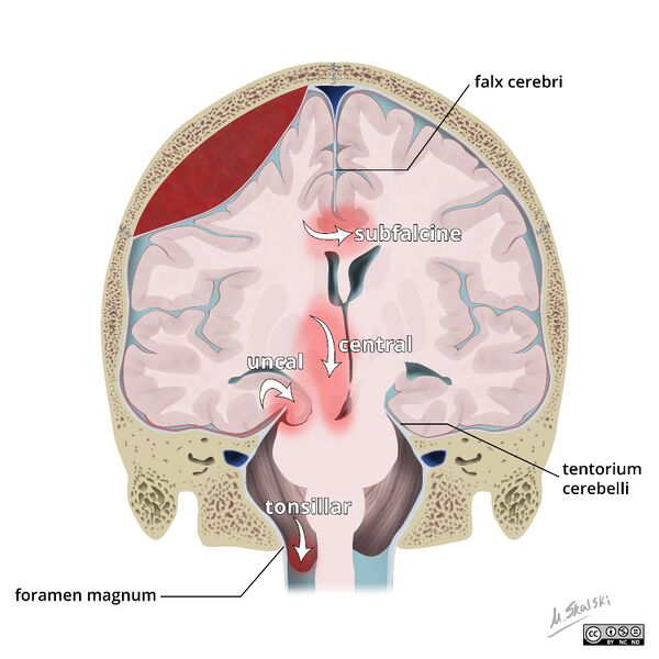File:Brain herniation types (Radiopaedia 45683-49865 None 4).jpg