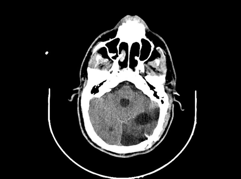 File:Brain injury by firearm projectile (Radiopaedia 82068-96088 A 91).jpg