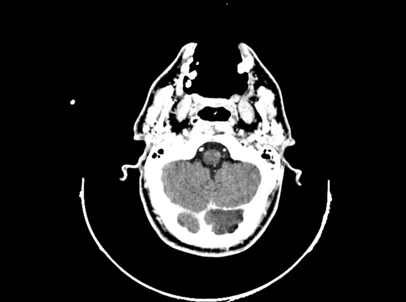 File:Brain injury by firearm projectile (Radiopaedia 82068-96088 B 69).jpg