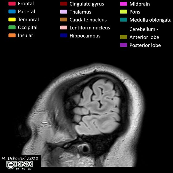 File:Brain lobes - annotated MRI (Radiopaedia 61691-69700 Sagittal 2).JPG