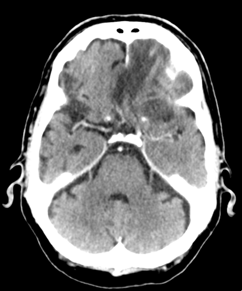 File:Brain metastasis (lung cancer) (Radiopaedia 48289-53177 Axial C+ 8).png