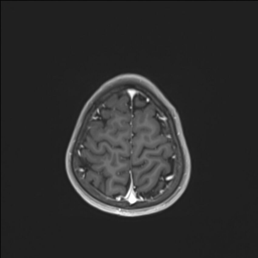 Brainstem glioma (Radiopaedia 70548-80674 Axial T1 C+ 135).jpg