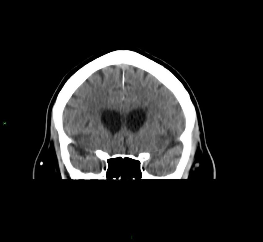 Brainstem hemorrhage (Radiopaedia 58794-66028 Coronal non-contrast 44).jpg