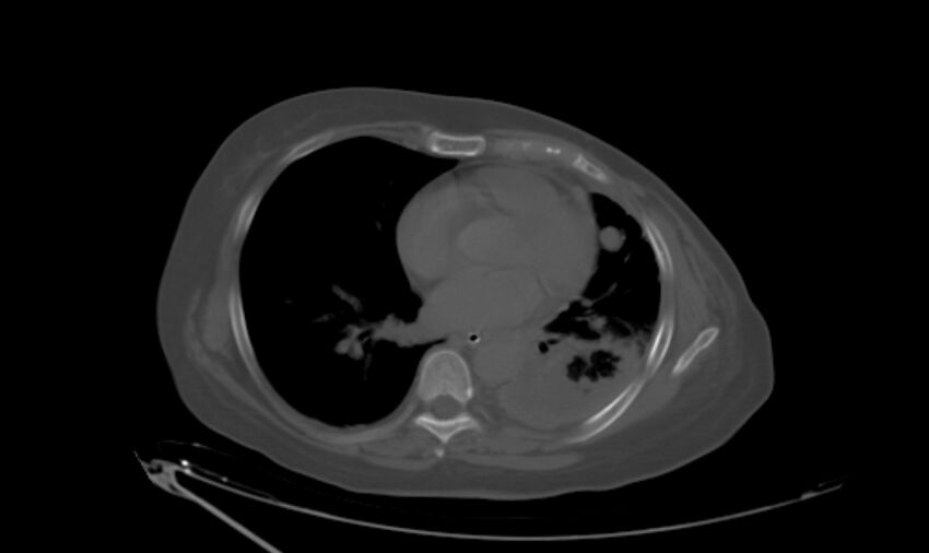 Breast cancer metastases (Radiopaedia 33184-34213 Axial bone window 2).jpg