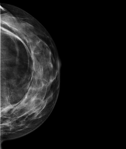 File:Breast lipoma (Radiopaedia 16321-16004 B 1).jpg