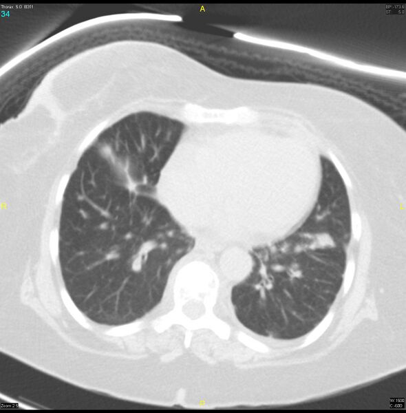 File:Breast primary with lung and bone metastases (Radiopaedia 40620-43228 Axial lung window 34).jpg