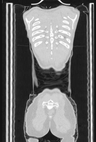 File:Bronchial carcinoid tumor (Radiopaedia 57187-64090 Coronal lung window 107).jpg