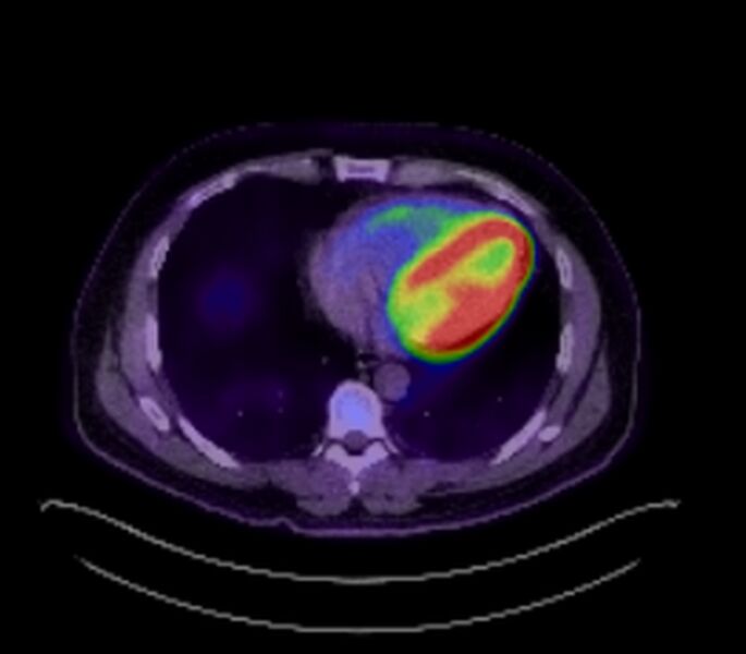 File:Bronchial carcinoid tumor (Radiopaedia 67377-76766 18FDG-PET-CT 33).jpg