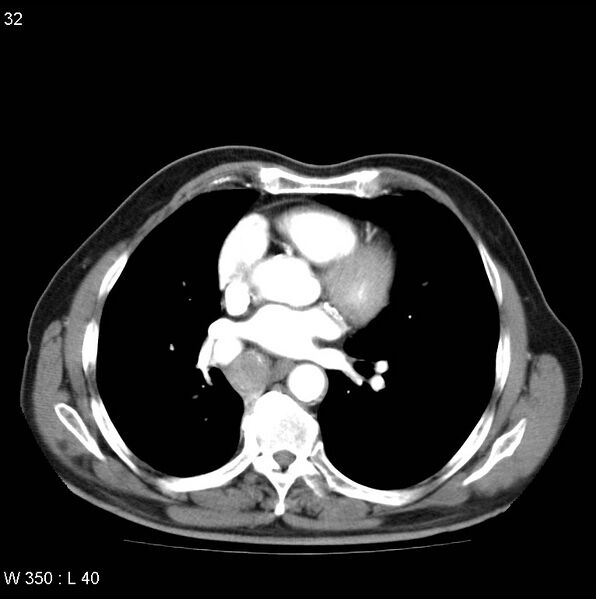 File:Bronchial carcinoid tumor with right lower lobe collapse (Radiopaedia 29060-29422 A 31).jpg