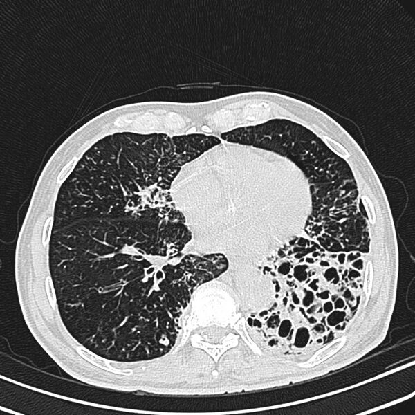 File:Bronchiectasis (Radiopaedia 22061-22059 lung window 20).jpg